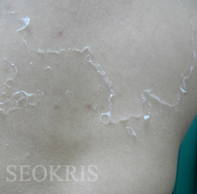 背中ニキビ ニキビ跡にはニューアラジンピーリング 19年11月日 12時37分 ピーリング専門店 Seokris Beauty Salonブログ Eparkリラク エステ