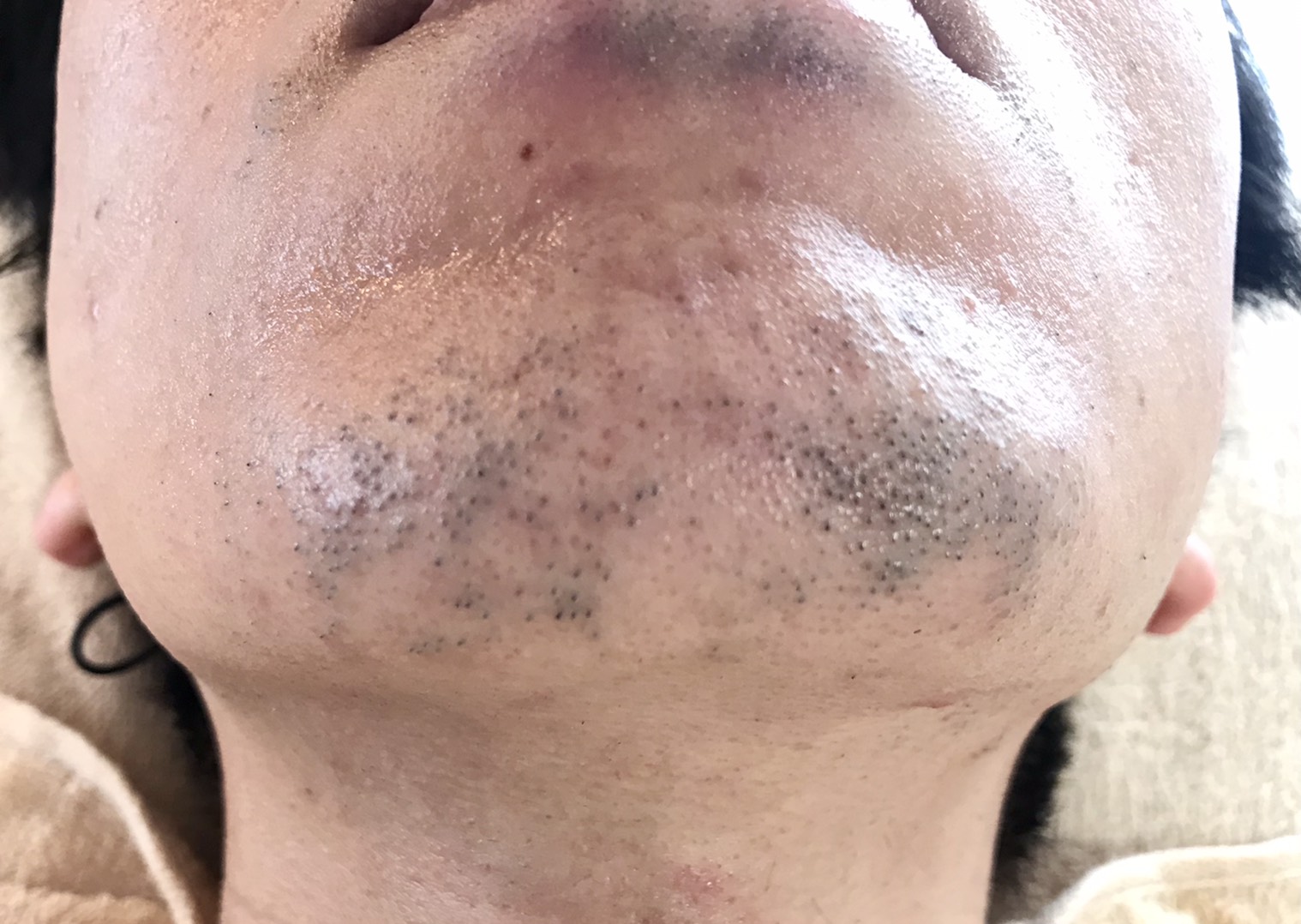 ひげ脱毛6回目のお客様 21年05月02日 11時30分 メンズ脱毛専門店 Adonis 海老名店ブログ Eparkリラク エステ