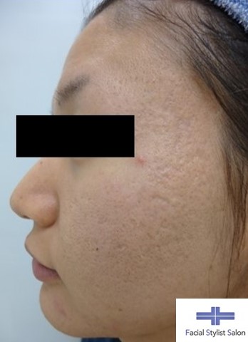 ニキビ肌 クレーター 21年05月24日 14時06分 肌能力回復フェイシャルスタイリストサロン高崎店ブログ Eparkリラク エステ