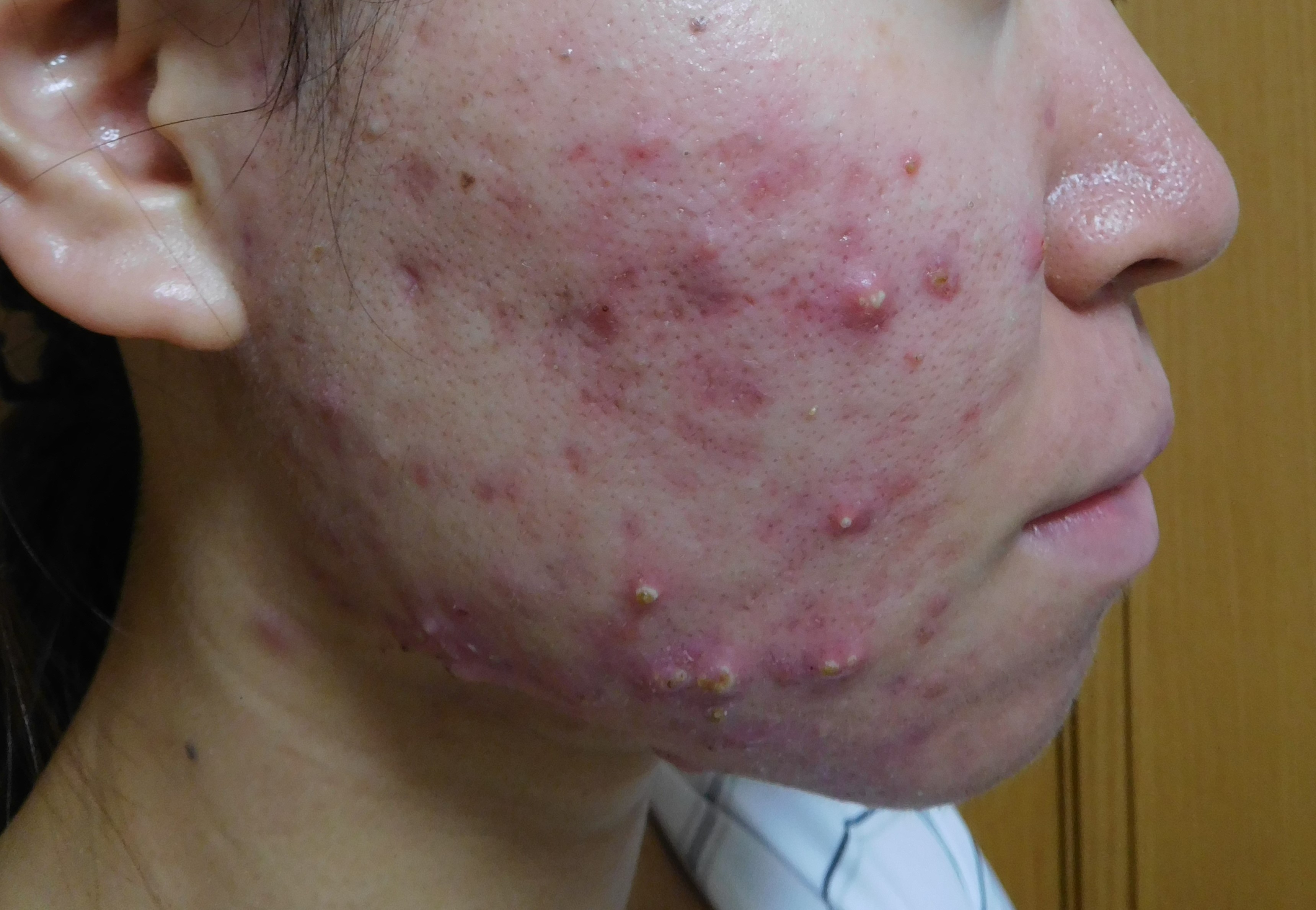 脂性肌とニキビ 21年07月01日 09時47分 肌能力回復フェイシャルスタイリストサロン高崎店ブログ Eparkリラク エステ