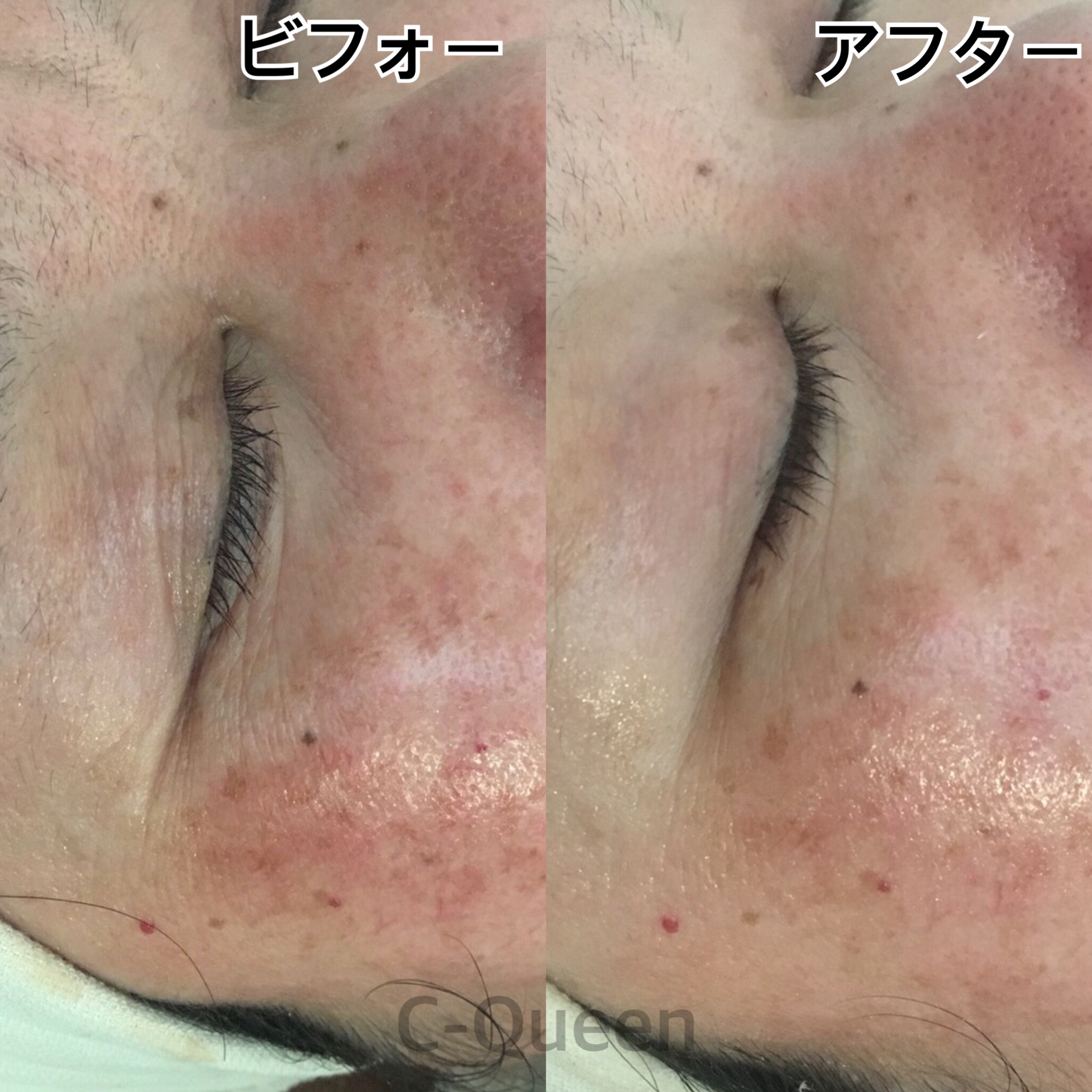 50代のお客様 赤み シワ改善 17年11月19日 12時35分 30代からの毛穴 エイジングケア専門店 C Queenブログ Eparkリラク エステ